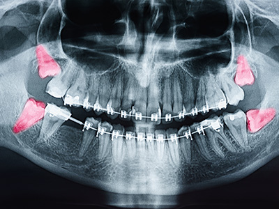 Phoenix Dental | Teeth Whitening, Intraoral Camera and Digital Impressions