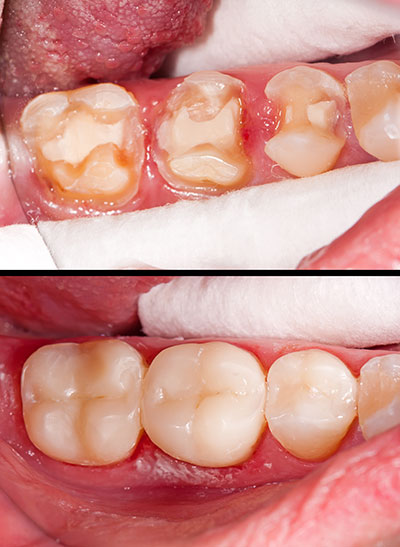 Phoenix Dental | Bone Grafts, Wisdom Teeth Extractions and Dental Bridges