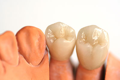 Phoenix Dental | Bone Grafts, Digital Impressions and Dental Fillings