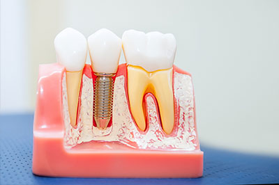 Phoenix Dental | Dental Bridges, Periodontal Treatment and Cosmetic Dentistry