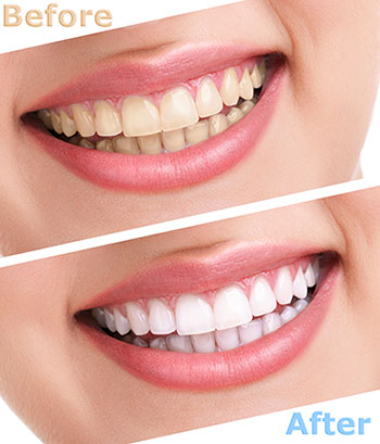 Phoenix Dental | Dental Fillings, Emergency Treatment and Internal Bleaching