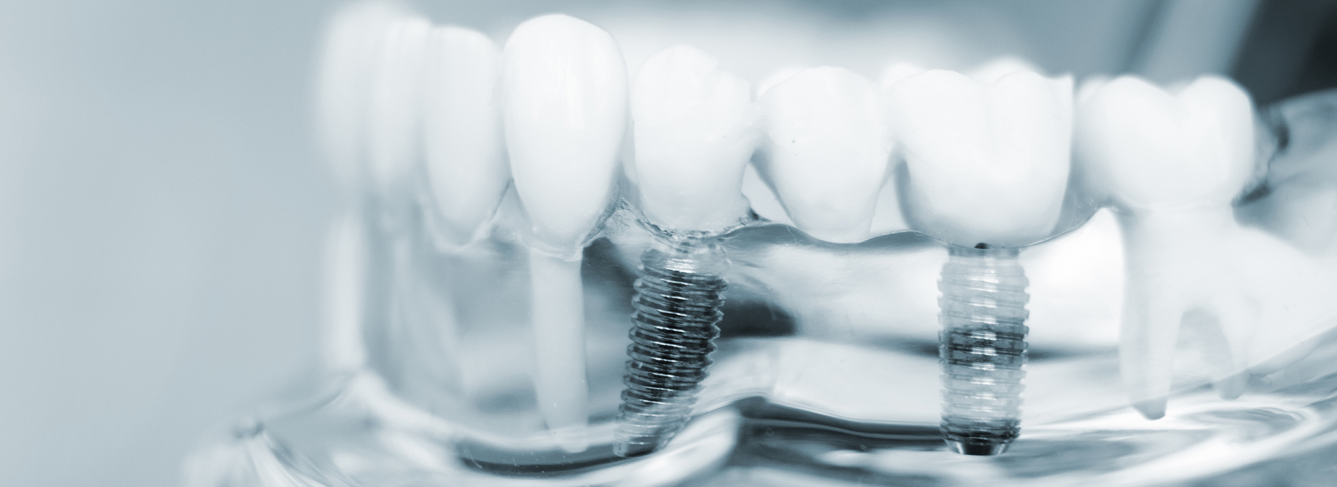 Phoenix Dental | Dental Fillings, Dental Sealants and Night Guards