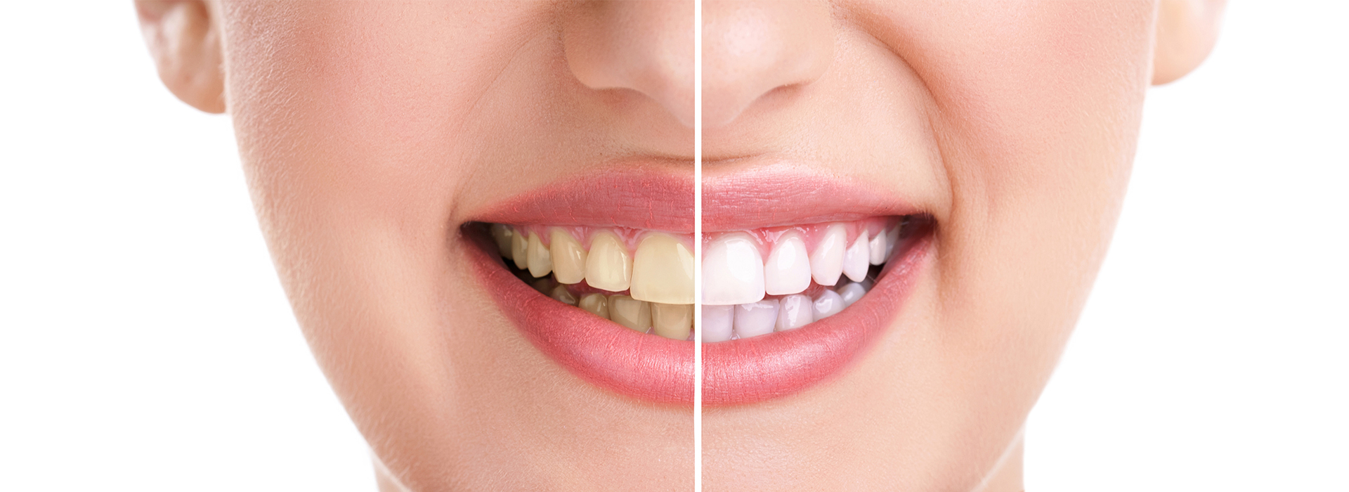 Phoenix Dental | Invisalign reg , Veneers and Teeth Whitening