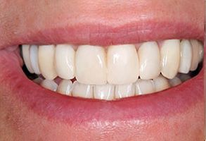Phoenix Dental | Fluoride Treatment, Dentures and Ceramic Crowns