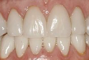 Phoenix Dental | Internal Bleaching, Bone Grafts and Digital Impressions