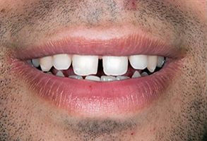 Phoenix Dental | SureSmile   Aligners, Night Guards and Periodontal Treatment