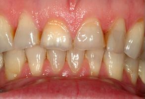 Phoenix Dental | Invisalign reg , Internal Bleaching and Fluoride Treatment