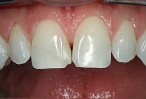 Phoenix Dental | Invisalign reg , Teeth Whitening and ClearCorrect reg 